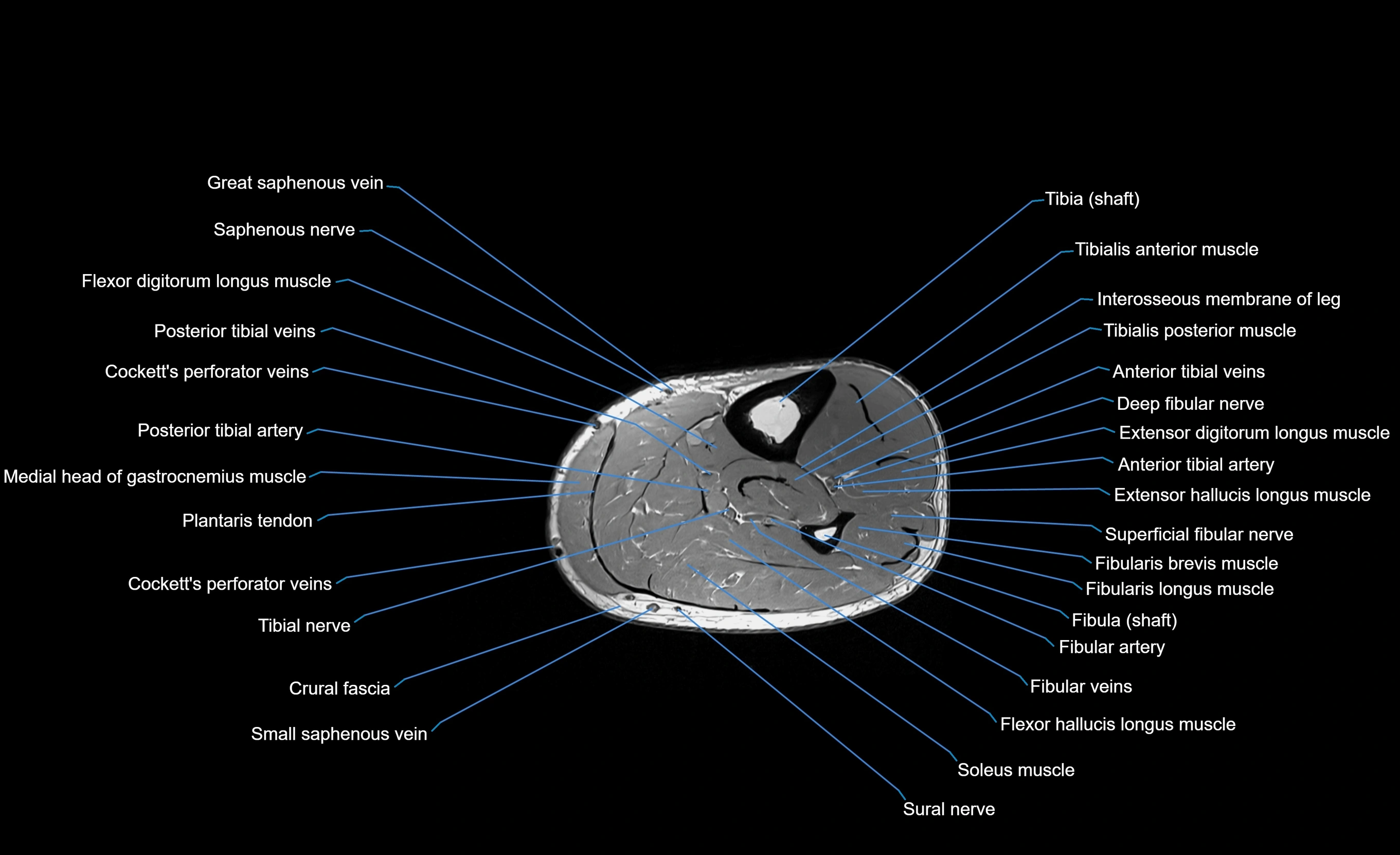 MRI lower leg axial cross sectional anatomy 3T  radiology  image-img-00001-00053.webp